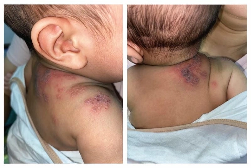 Trẻ nhỏ bị zona cần được chăm sóc đúng cách