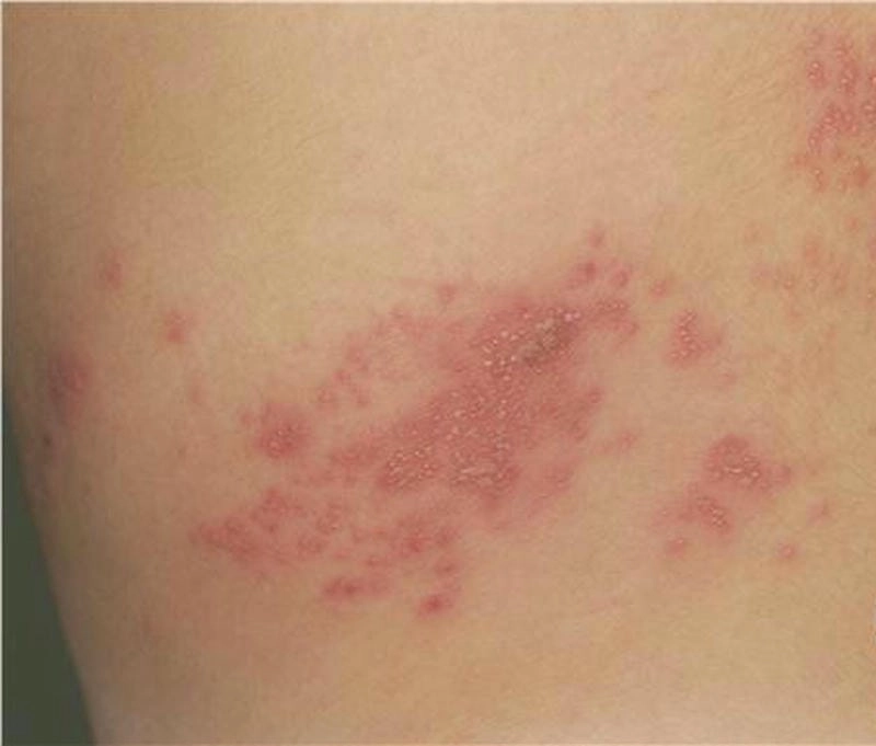 Ảnh bệnh zona ở trẻ em giúp nhận diện sớm
