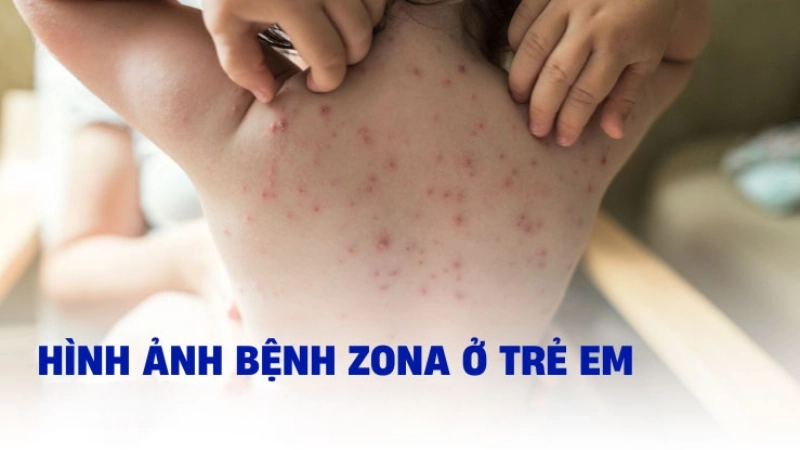Ảnh zona ở trẻ em thể hiện rõ vùng tổn thương