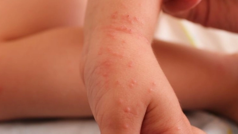 Zona ở trẻ em và những dấu hiệu cần lưu ý